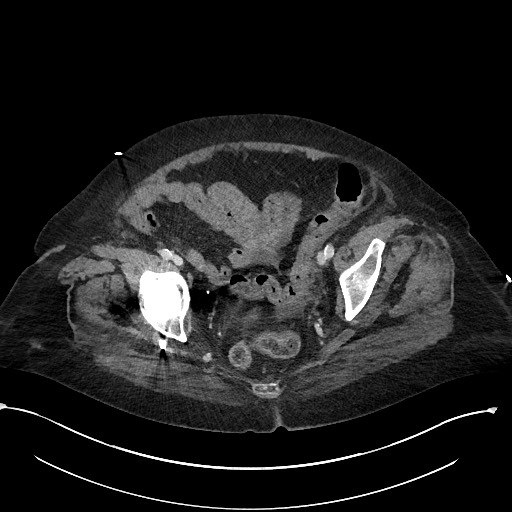 File:Active renal extravasation with large subcapsular and retroperitoneal hemorrhage (Radiopaedia 60975-68796 Axial 302).jpg