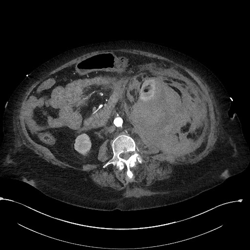 File:Active renal extravasation with large subcapsular and retroperitoneal hemorrhage (Radiopaedia 60975-68796 Axial 31).jpg