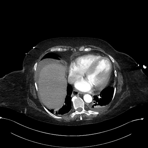 File:Active renal extravasation with large subcapsular and retroperitoneal hemorrhage (Radiopaedia 60975-68796 Axial C+ arterial phase 21).jpg