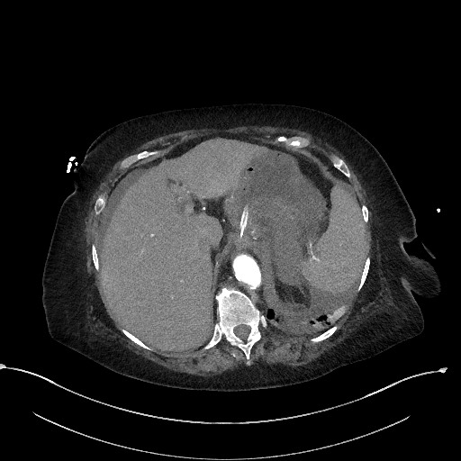 Active renal extravasation with large subcapsular and retroperitoneal hemorrhage (Radiopaedia 60975-68796 Axial C+ arterial phase 41).jpg
