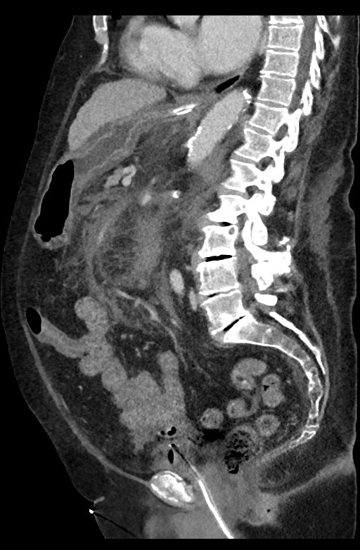 Active renal extravasation with large subcapsular and retroperitoneal hemorrhage (Radiopaedia 60975-68796 Sagittal C+ portal venous phase 115).jpg