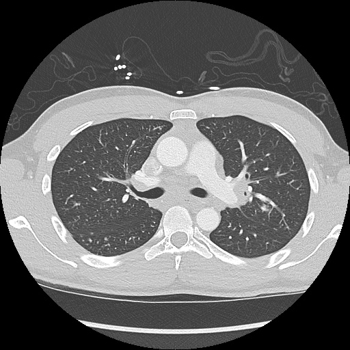 File:Active right ventricular cardiac sarcoidosis (Radiopaedia 55596-62101 Axial lung window 16).jpg