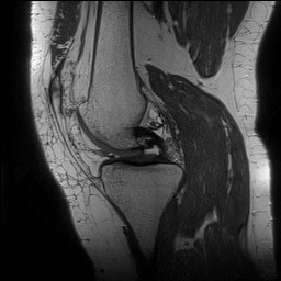Acute-on-chronic transient lateral patellar dislocation with trochlear dysplasia (Radiopaedia 84099-99349 Sagittal PD 69).jpg