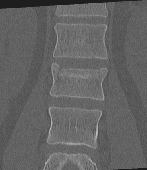 Acute L1 burst compression fracture (Radiopaedia 34430-35755 Coronal bone window 29).png