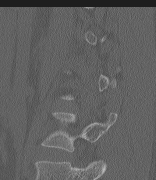 Acute L1 burst compression fracture (Radiopaedia 34430-35755 Sagittal bone window 48).png