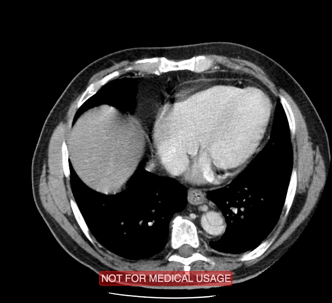 Acute aortic dissection - Stanford type A (Radiopaedia 40661-43285 Axial C+ portal venous phase 43).jpg