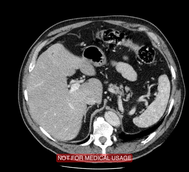 Acute aortic dissection - Stanford type A (Radiopaedia 40661-43285 Axial C+ portal venous phase 70).jpg