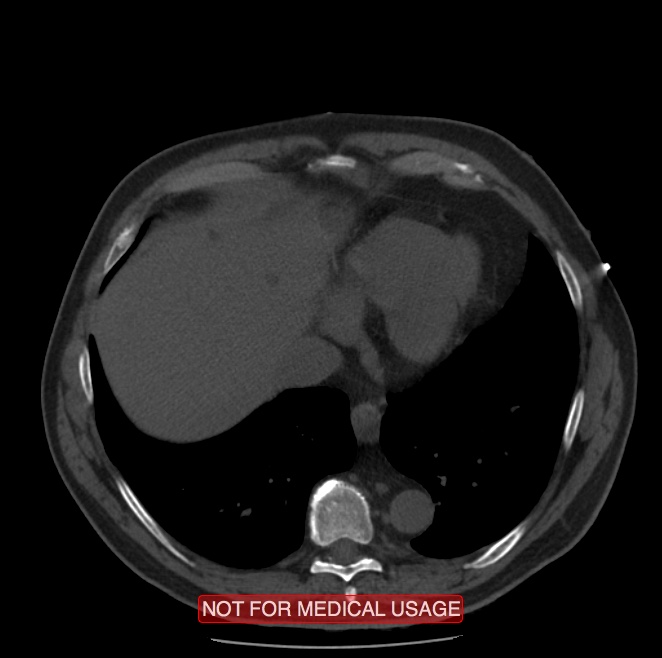 Acute aortic dissection - Stanford type A (Radiopaedia 40661-43285 Axial non-contrast 54).jpg