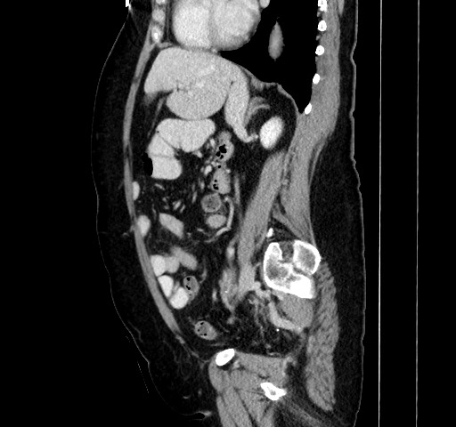 Acute appendicitis, heterotaxy syndrome (Radiopaedia 66884-76202 Sagittal C+ portal venous phase 83).jpg