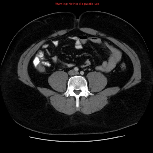 File:Acute appendicitis (Radiopaedia 12326-12607 Axial C+ portal venous phase 13).jpg