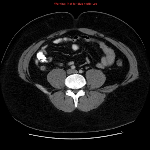 File:Acute appendicitis (Radiopaedia 12326-12607 Axial C+ portal venous phase 17).jpg