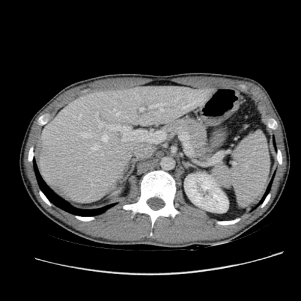 Acute appendicitis (Radiopaedia 27049-27227 Axial C+ portal venous phase 18).jpg