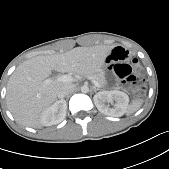 File:Acute appendicitis (Radiopaedia 32614-33572 Axial C+ portal venous phase 16).jpg