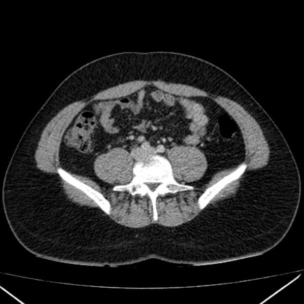Acute appendicitis (Radiopaedia 38255-40270 Axial C+ portal venous phase 69).jpg