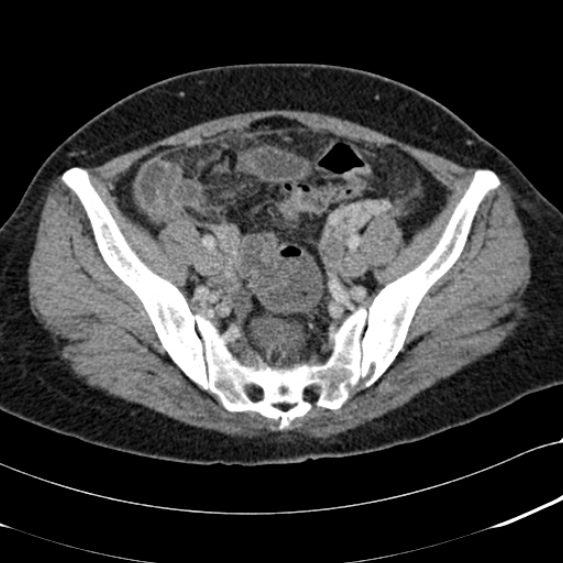 File:Acute appendicitis (Radiopaedia 48792-53822 Axial C+ portal venous phase 92).jpg