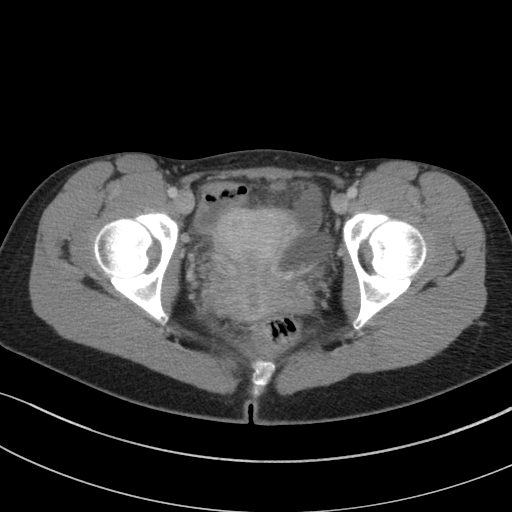 File:Acute appendicitis (Radiopaedia 62608-70901 Axial C+ portal venous phase 51).jpg