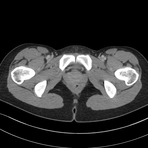 Acute appendicitis (Radiopaedia 62608-70901 Axial C+ portal venous phase 65).jpg