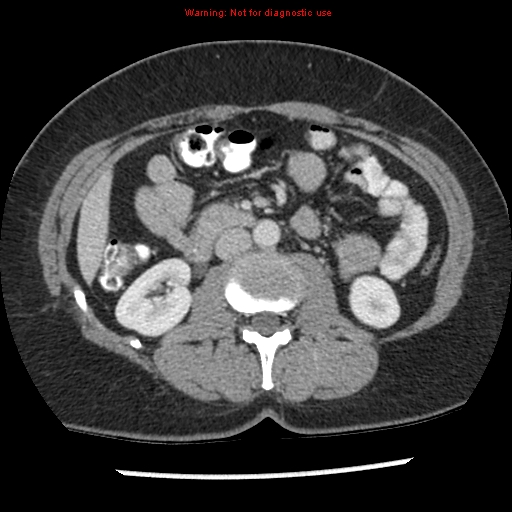 File:Acute appendicitis (Radiopaedia 7966-8812 C+ portal venous phase 19).jpg