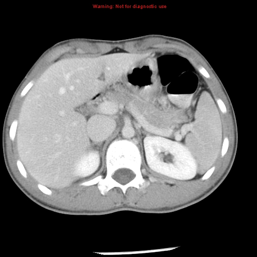 Acute appendicitis (Radiopaedia 8195-9045 Axial C+ portal venous phase 20).jpg