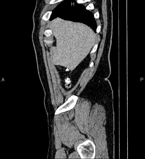 Acute appendicitis (Radiopaedia 84780-100240 Sagittal C+ portal venous phase 8).jpg