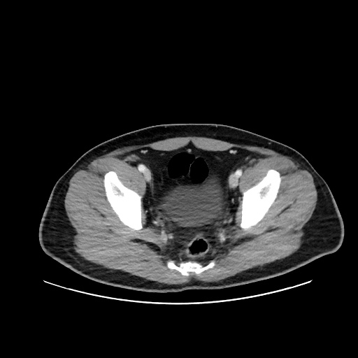 Acute appendicitis and COVID 19 pneumonia (Radiopaedia 76604-88380 Axial C+ portal venous phase 74).jpg