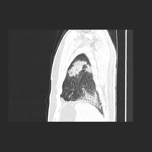 Acute appendicitis and COVID 19 pneumonia (Radiopaedia 76604-88380 Sagittal lung window 82).jpg