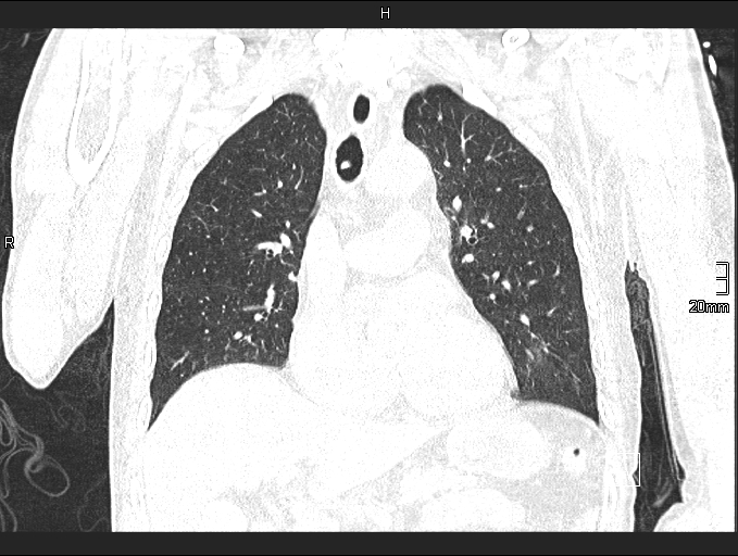 File:Acute aspiration pneumonitis (Radiopaedia 55642-62166 Coronal lung window 43).jpg