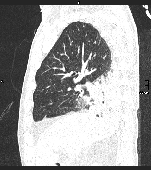 File:Acute aspiration pneumonitis (Radiopaedia 55642-62166 Sagittal lung window 104).jpg