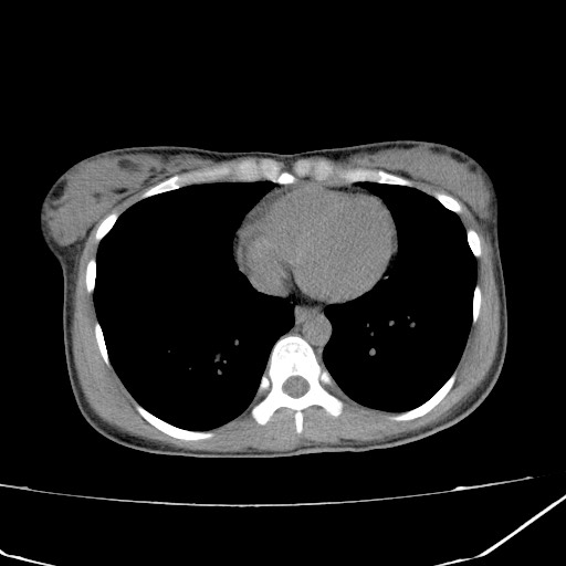 Acute bilateral pyelonephritis (Radiopaedia 74153-84969 Axial non-contrast 2).jpg