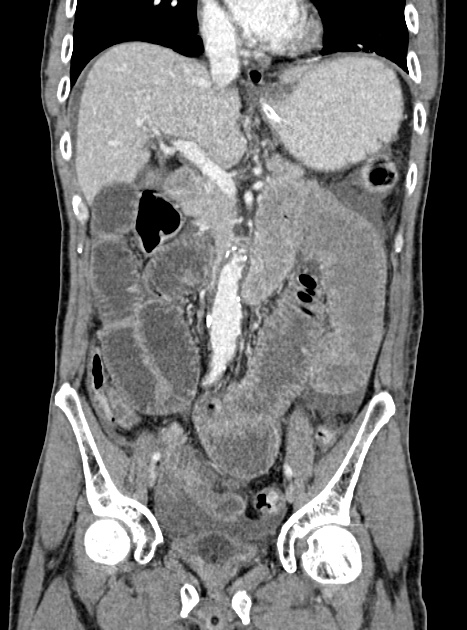 Acute bowel ischemia (Radiopaedia 87695-104114 Coronal C+ portal venous phase 190).jpg