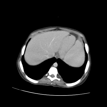 Acute calculous cholecystitis in patient with osteopetrosis (Radiopaedia 77871-90159 Axial C+ portal venous phase 19).jpg