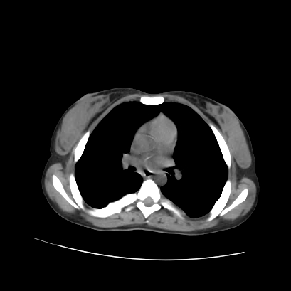 File:Acute calculous cholecystitis in patient with osteopetrosis (Radiopaedia 77871-90159 Axial non-contrast 2).jpg