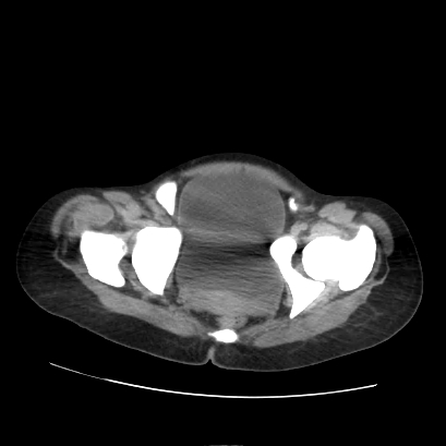 File:Acute calculous cholecystitis in patient with osteopetrosis (Radiopaedia 77871-90159 Axial non-contrast 74).jpg