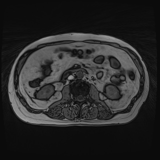 File:Acute cholecystitis (Radiopaedia 72392-82923 Axial T1 out-of-phase 75).jpg