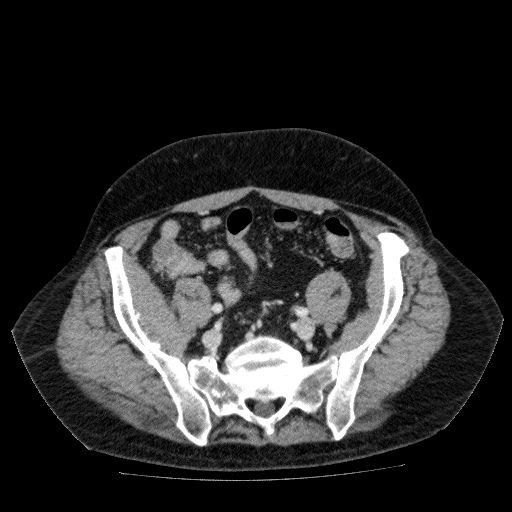 File:Acute cholecystitis and incidental left sided IVC (Radiopaedia 49352-54459 Axial C+ portal venous phase 117).jpg