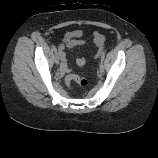 Acute cholecystitis and ureteric colic (Radiopaedia 42330-45444 Axial prone 91).jpg
