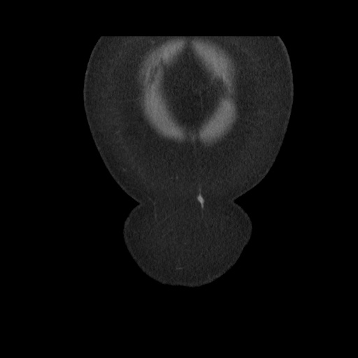 File:Acute cholecystitis with tensile fundus sign (Radiopaedia 71394-81723 Coronal non-contrast 18).jpg