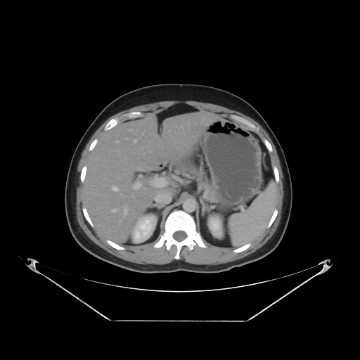 File:Acute complicated calculous cholecystitis (Radiopaedia 55202-61587 Axial C+ delayed 31).jpg
