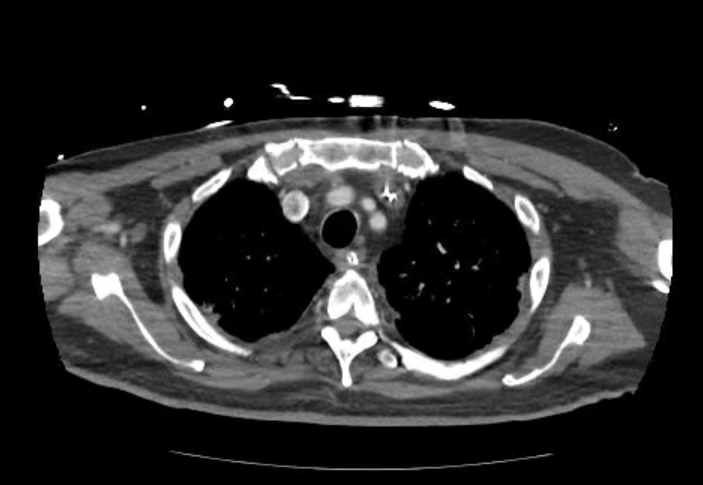 File:Acute cor pulmonale (ultrasound) (Radiopaedia 83508-98818 Axial C+ CTPA 12).jpg