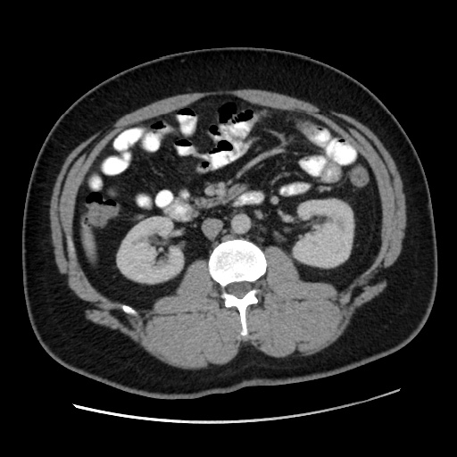 File:Acute diverticulitis with localized perforation (Radiopaedia 41296-44113 Axial C+ portal venous phase 41).jpg