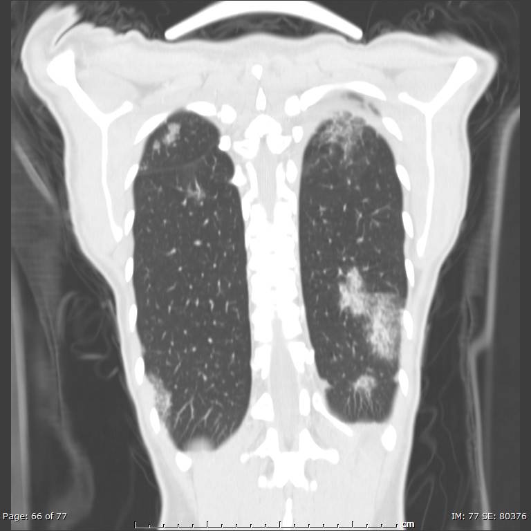 Acute eosinophilic pneumonia (Radiopaedia 48211-53073 Coronal lung window 45).jpg