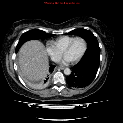 Acute gangrenous cholecystitis (Radiopaedia 10123-10661 Axial C+ portal venous phase 6).jpg