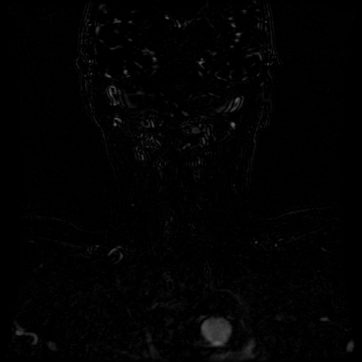 Acute internal carotid artery dissection (Radiopaedia 53541-59632 Coronal MRA 9).jpg