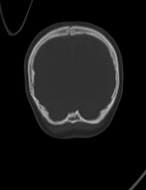 Acute mastoiditis (Radiopaedia 82678-96881 Coronal bone window 73).jpg