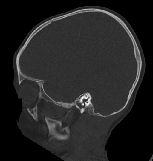 Acute mastoiditis (Radiopaedia 82678-96881 Sagittal bone window 48).jpg