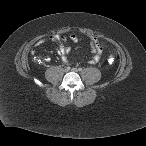 Acute mesenteric venous ischemia (Radiopaedia 46041-50383 Axial C+ portal venous phase 89).jpg