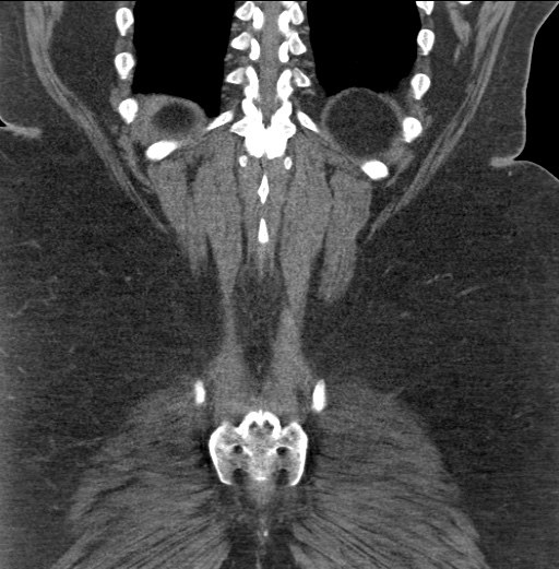 Acute mesenteric venous ischemia (Radiopaedia 46041-50383 Coronal C+ portal venous phase 84).jpg