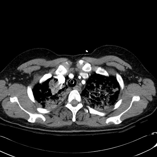 Acute myocardial infarction in CT (Radiopaedia 39947-42415 Axial C+ arterial phase 25).jpg