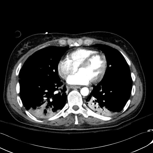 File:Acute myocardial infarction in CT (Radiopaedia 39947-42415 Axial C+ arterial phase 90).jpg