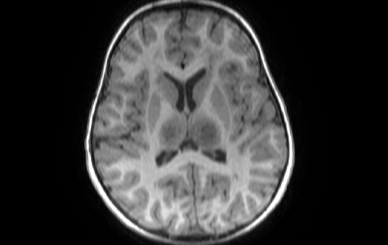 File:Acute necrotizing encephalitis of childhood (Radiopaedia 67356-76737 Axial T1 41).jpg